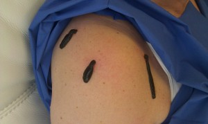 leeches on shoulder